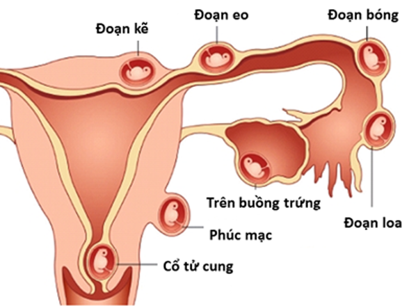 Hình minh họa: Thai ngoài từ cung