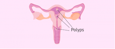 Hình minh họa: Polyps lòng tử cung