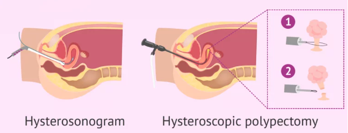 Hình minh họa (A): Siêu âm bơm nước BTC. (B): Nội soi buồng tử cung